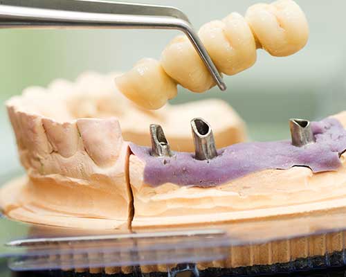 ODBUDOWY NA IMPLANTACH